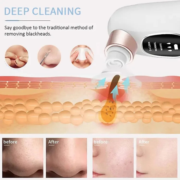 Blackhead Remover-أداة شفط لتنظيف المسام